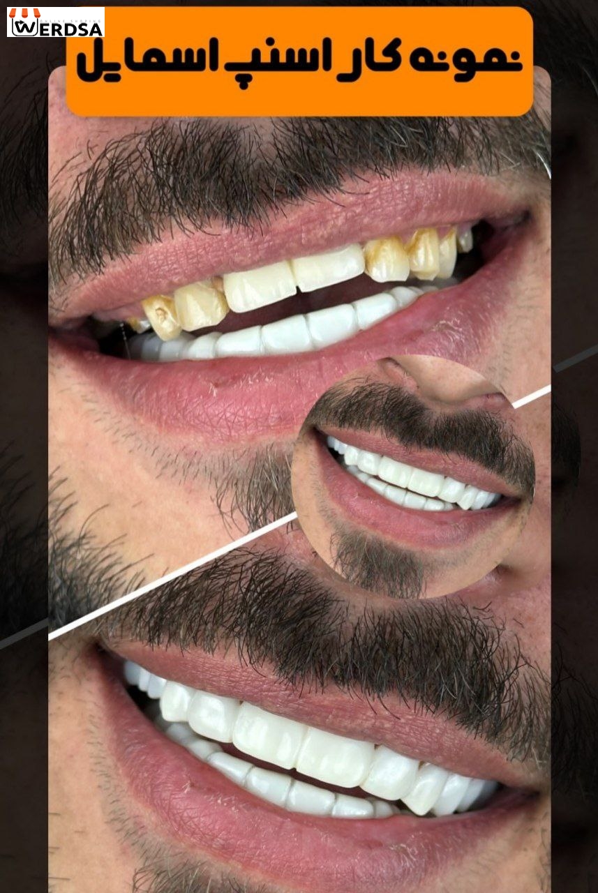اسنپ اسمایل snap on smile برای دو فک اصلی